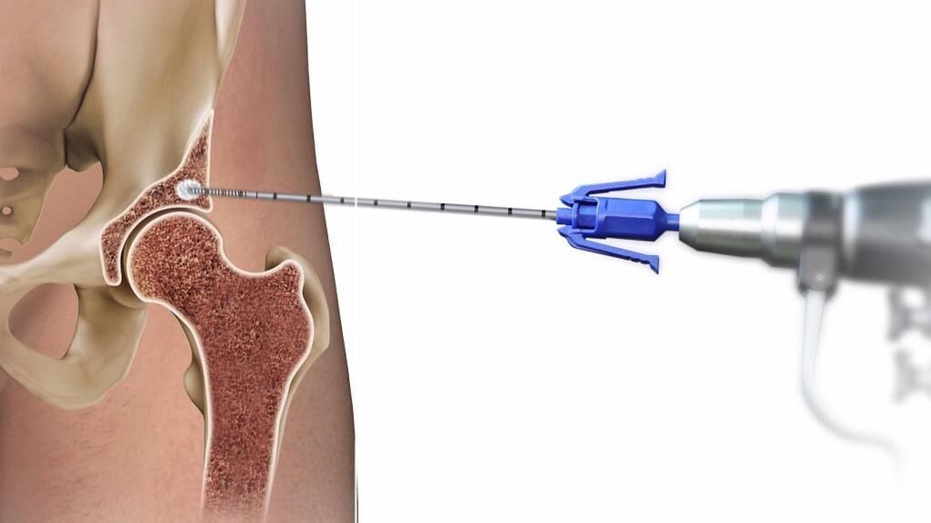 injection into the hip joint