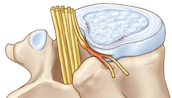 Protrusion of the intervertebral disc that occurs with thoracic osteochondrosis compresses nerve endings