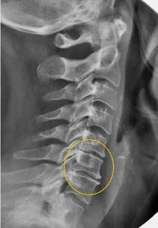 Cervical spinal osteochondrosis on x -ray
