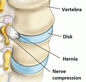 Osteochondrosis of the cervical area