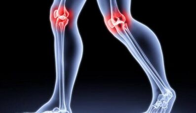 Prevention of development of arthritis and arthrosis