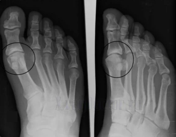 Diagnosis of arthrosis