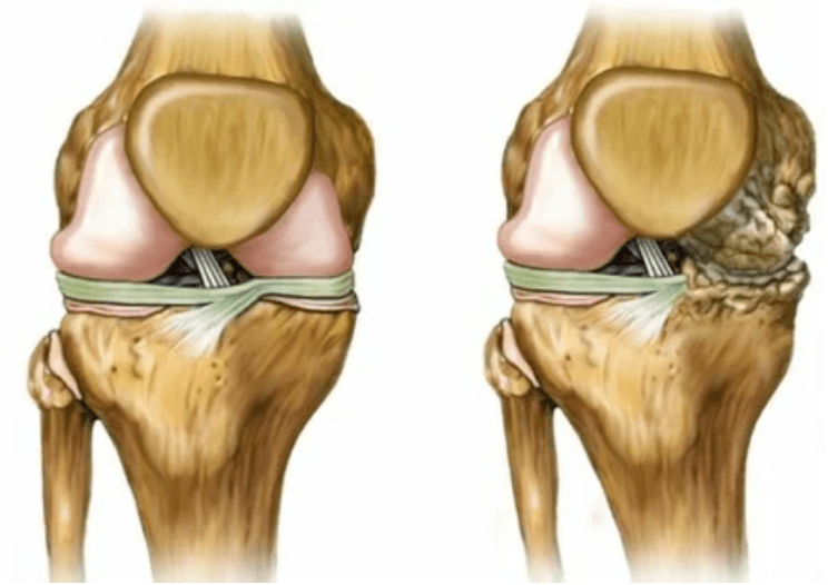 Stage of arthrosis