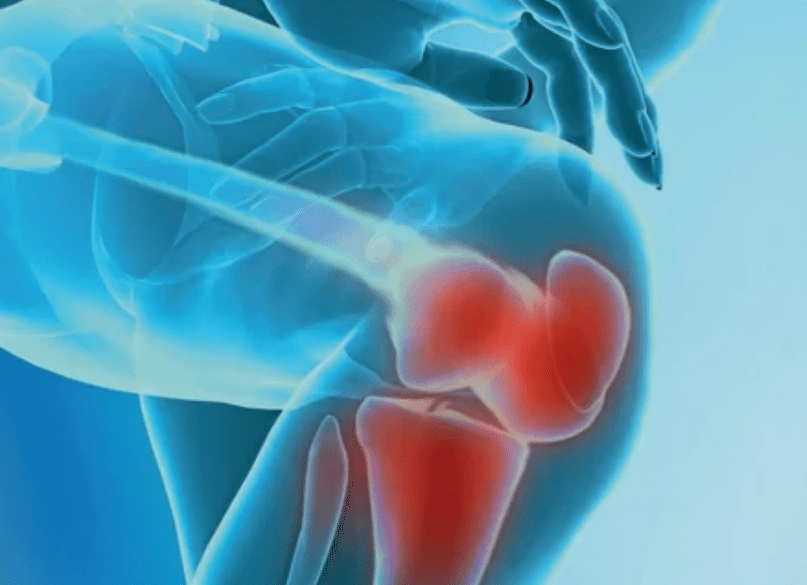 What is arthrosis