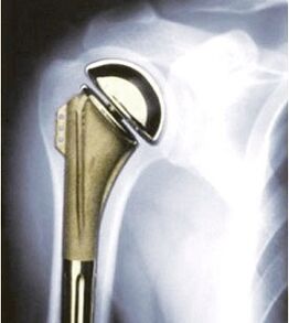 Shoulder replacement for arthrosis