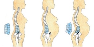stage of development of lumbar osteochondrosis