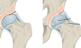 stage of development of hip arthrosis
