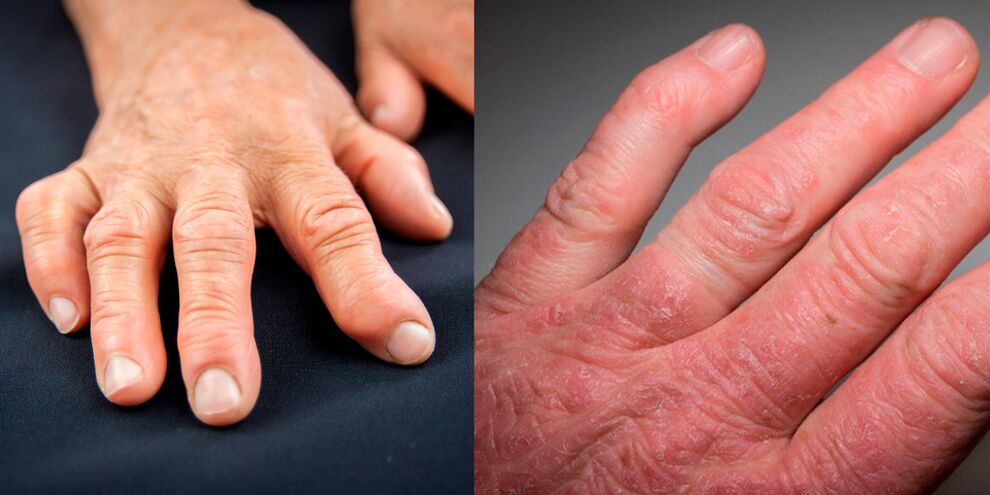 rheumatoid arthritis and psoriatic hand
