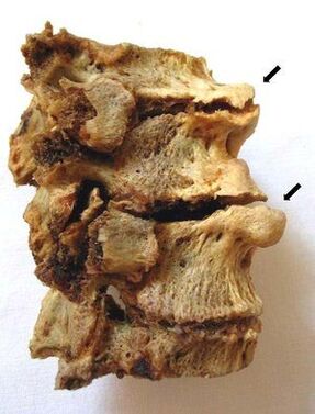 Parts of the vertebrae affected by osteochondrosis