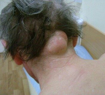 neoplasms as a cause of neck pain