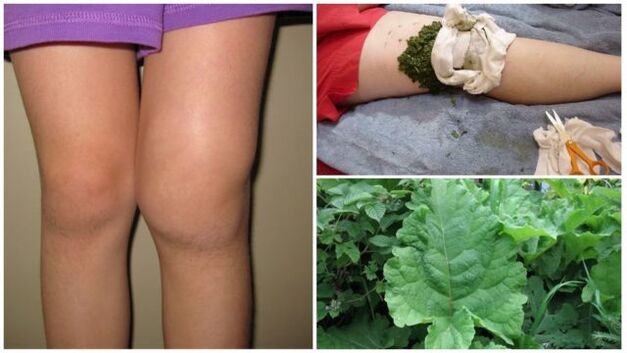 herbal compresses for knee osteoarthritis