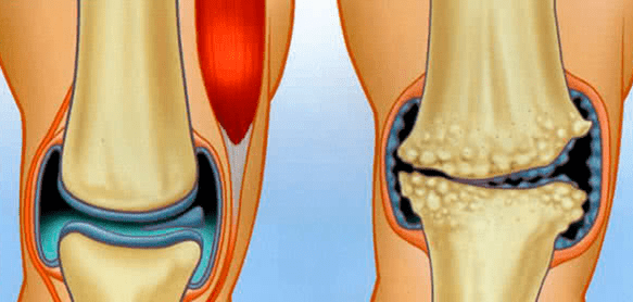 Normal joints and arthrosis
